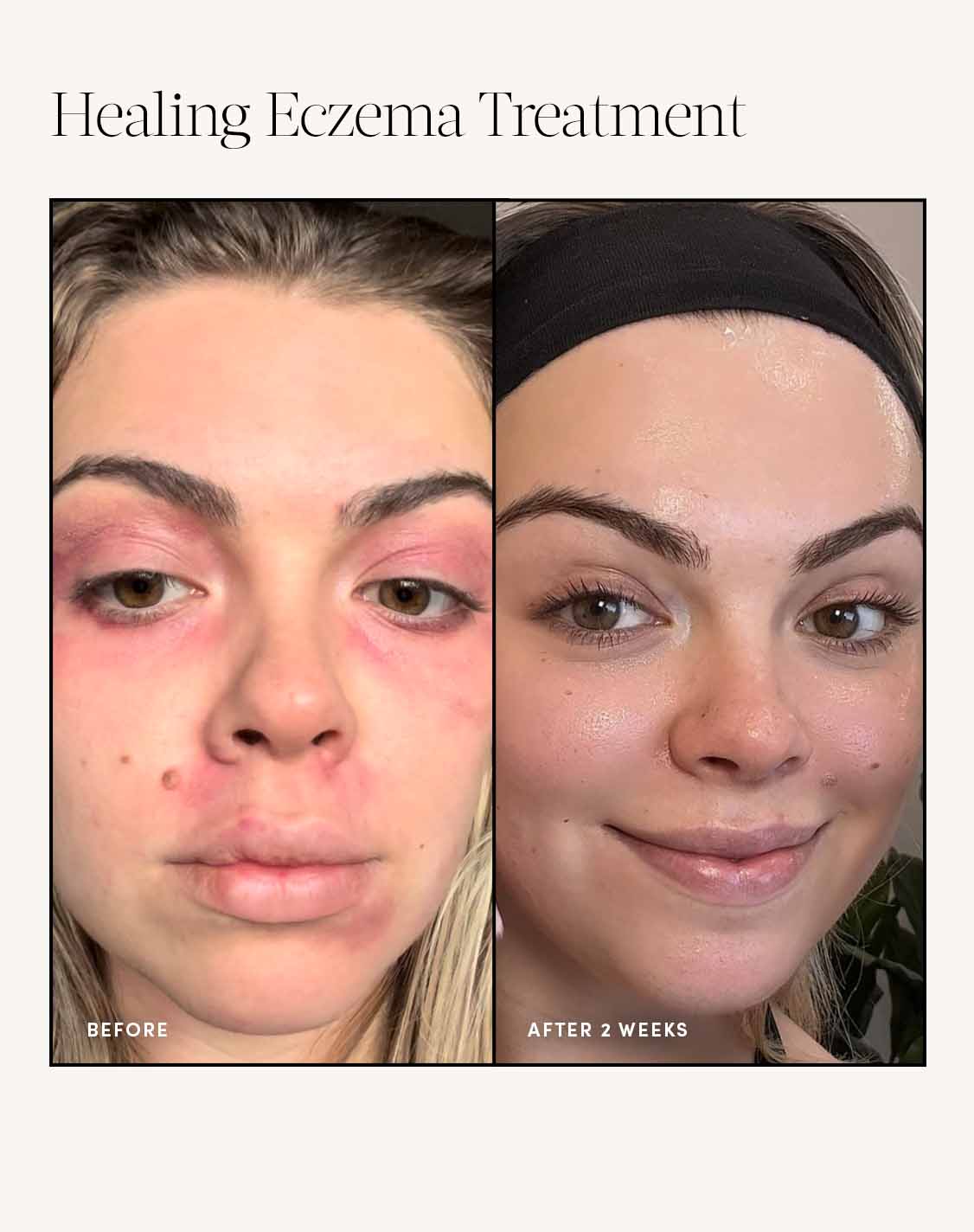 Healing Eczema Treatment - Image 3