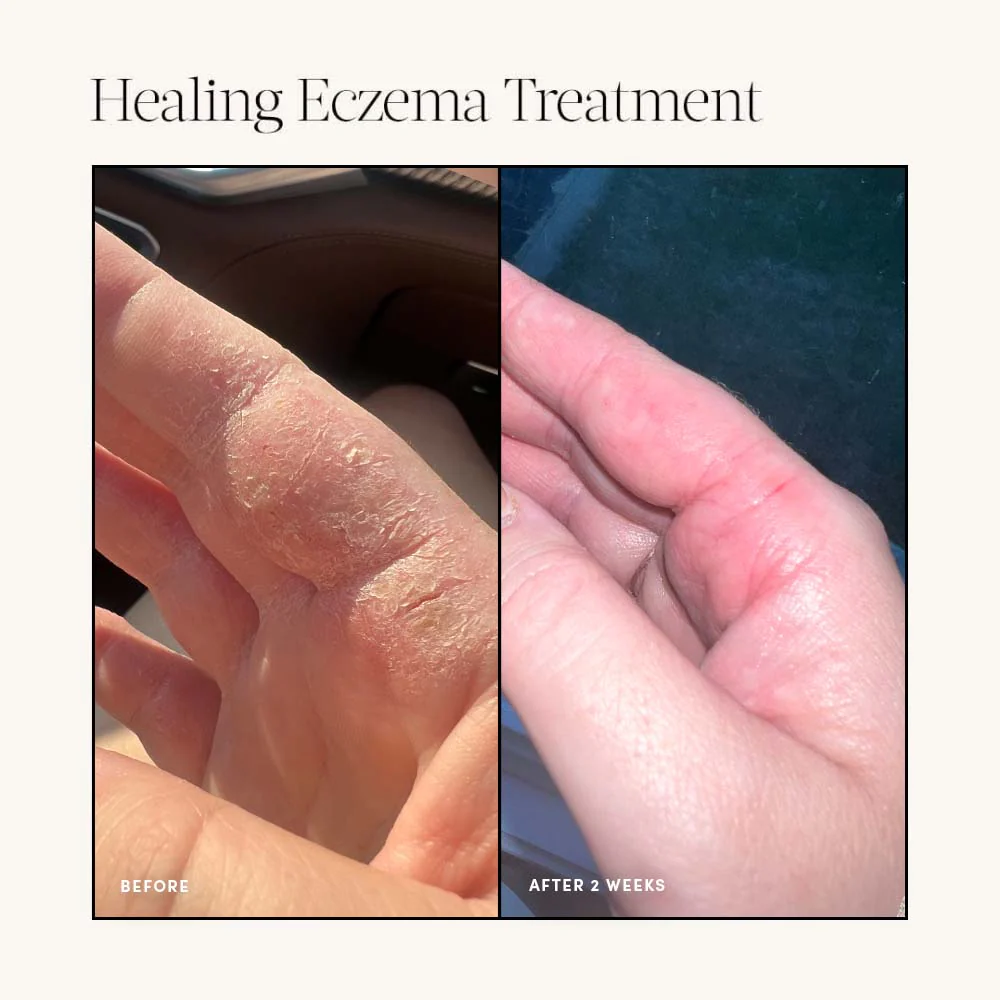 Healing Eczema Treatment - Image 7